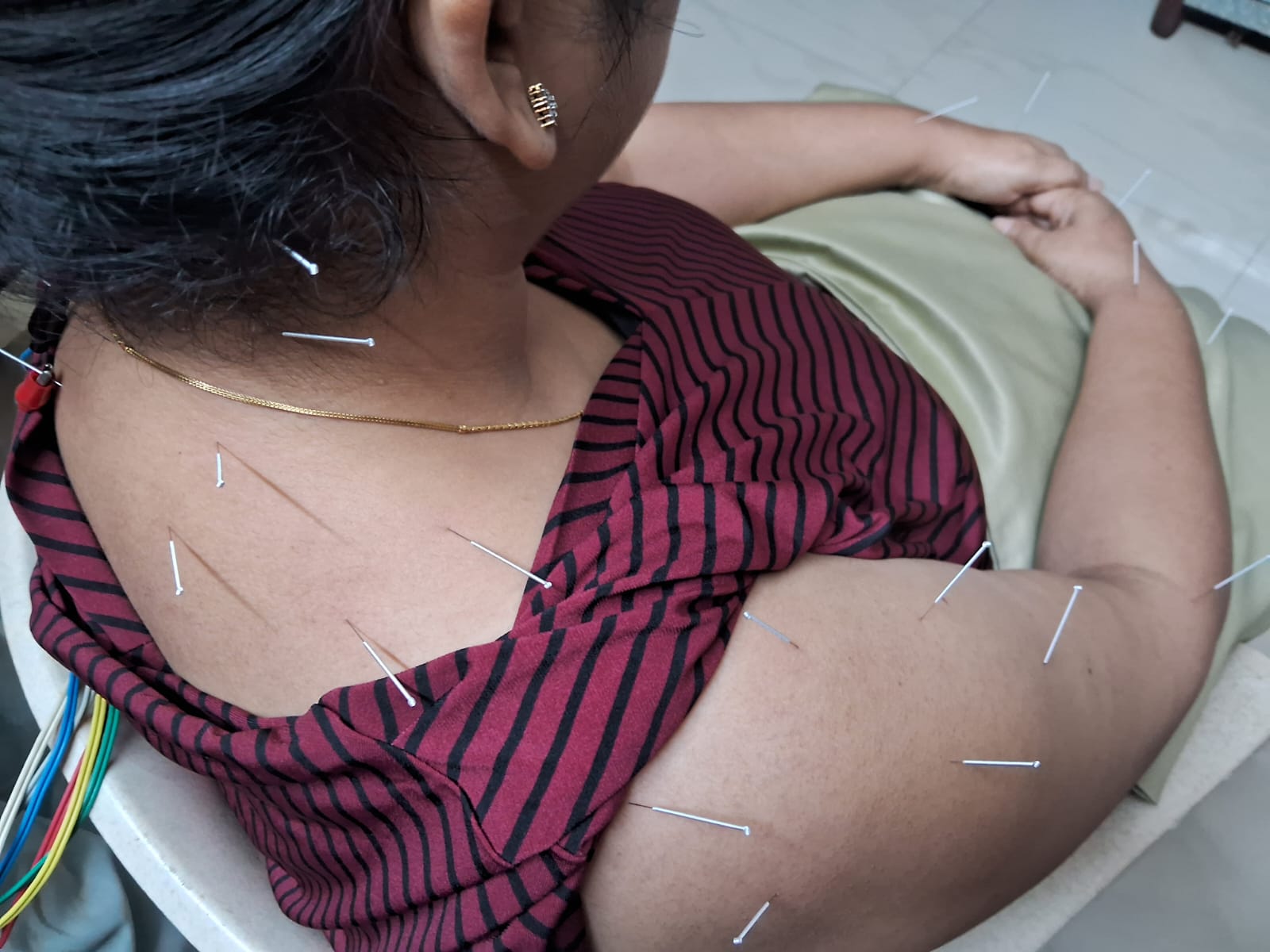 Medical acupuncture at Surat clinic