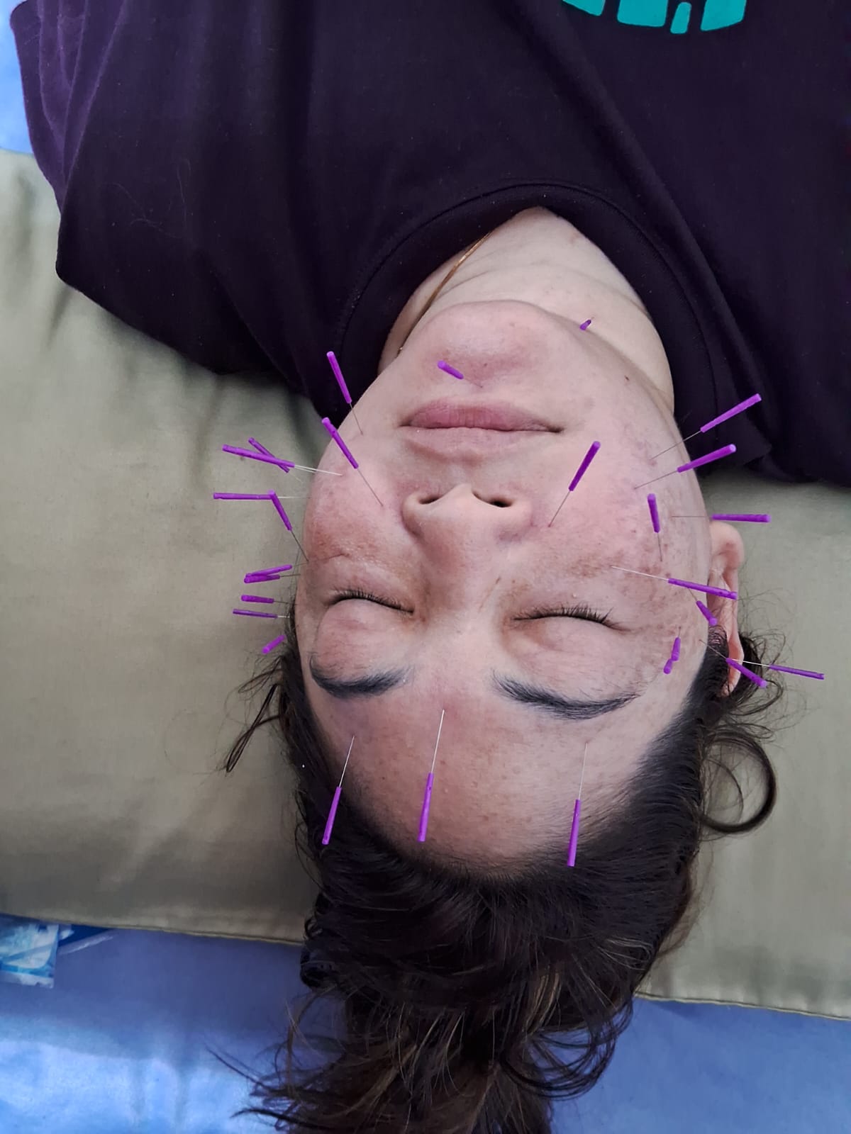 Medical acupuncture treatment at Mira Road clinic