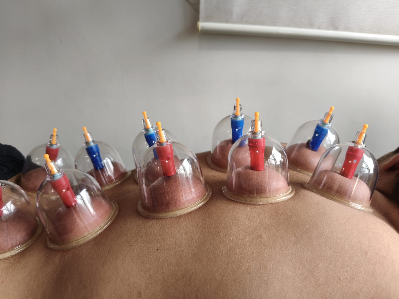 Cupping therapy session for muscle relief at Mira Road