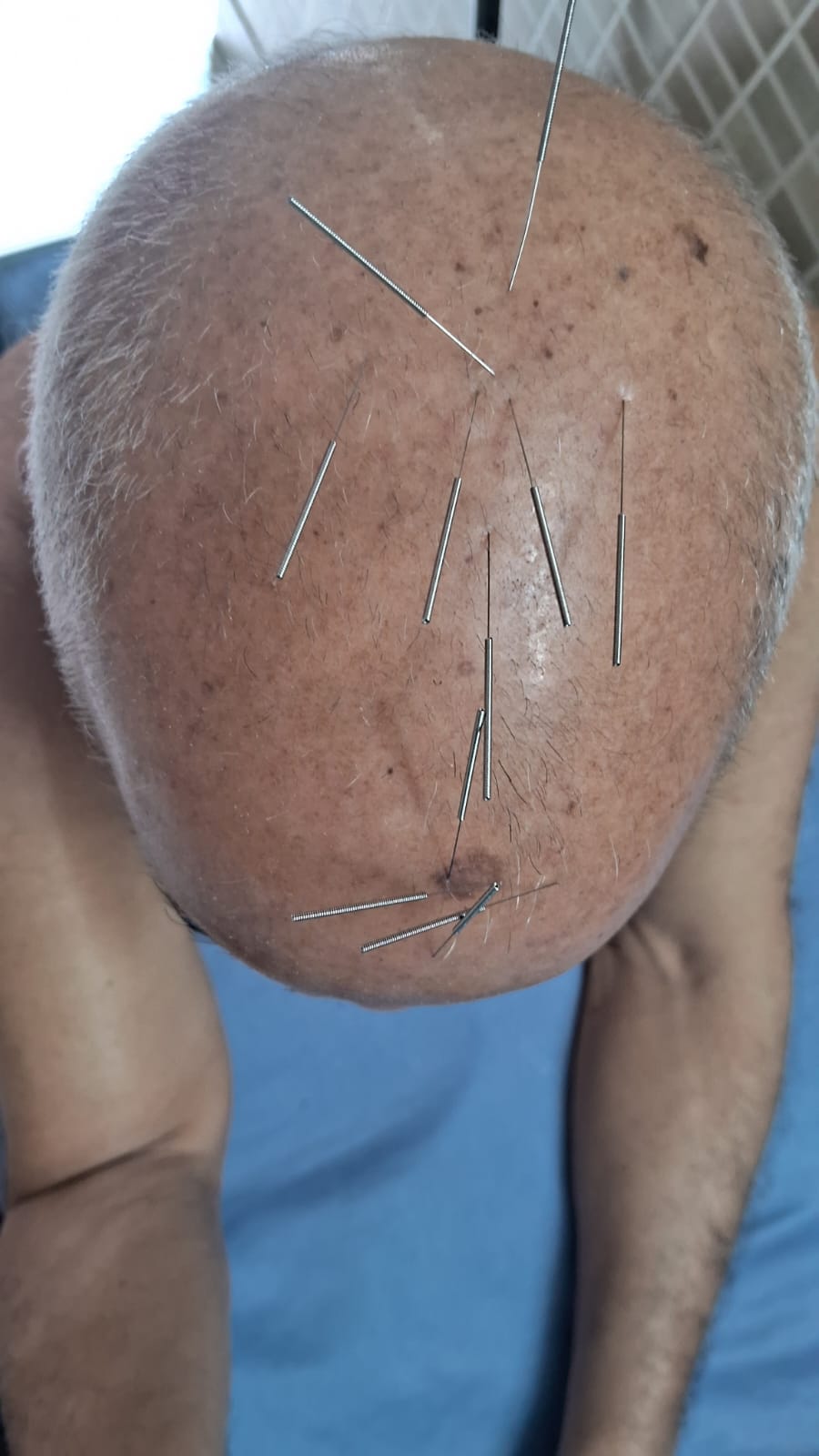 Scalp acupuncture session at Vasai clinic
